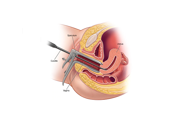 Dilation and curettage