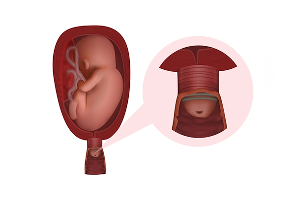 Cervical Cerclage