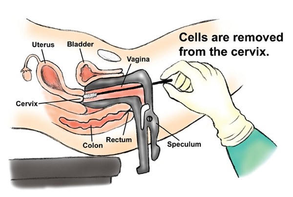 Pap Smear