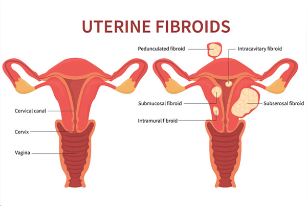 Fibroid Uterus