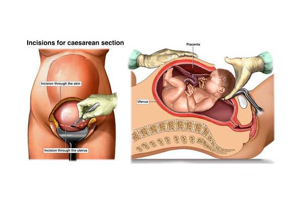 Cesarean Section