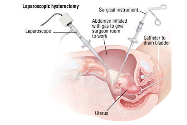 Hysterectomy