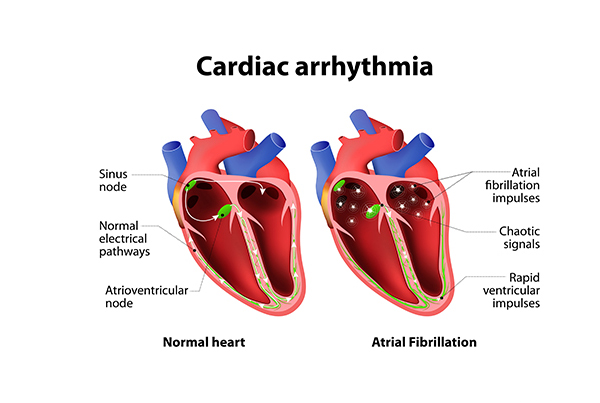 Arrhythmias