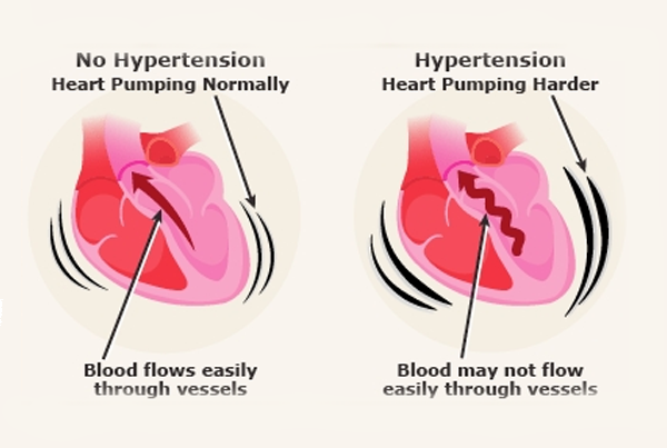 Hypertension