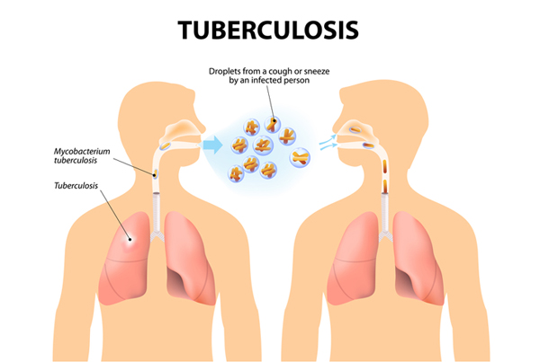 Asthma  and Allergy