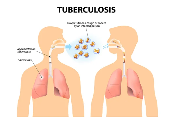Asthma  and Allergy